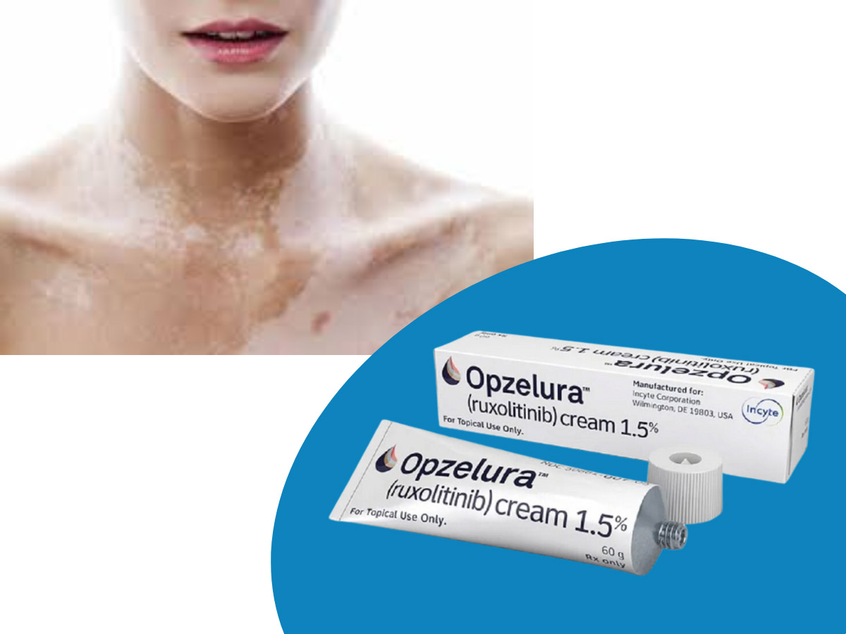 Thuốc Opzelura (Ruxolitinib) 1,5% được FDA phê duyệt trị bệnh bạch biến